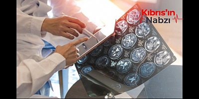 GÜNEY KIBRIS’TA 3 BİN CİVARINDA MS HASTASI VAR
