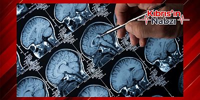 PROBİYOTİKLER ALZHEIMER İZLERİNİ AZALTABİLİR